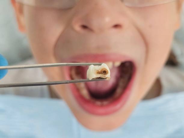 Best Emergency Root Canal Treatment in Kechi, KS